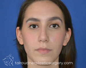 Nose Surgery (Rhinoplasty)