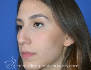 Nose Surgery (Rhinoplasty)