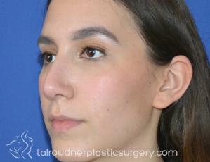 Nose Surgery (Rhinoplasty)