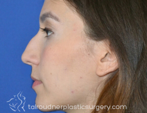 Nose Surgery (Rhinoplasty)
