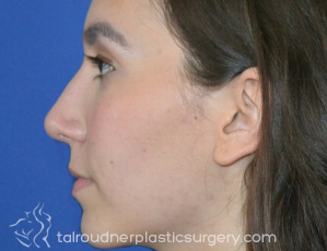 Nose Surgery (Rhinoplasty)