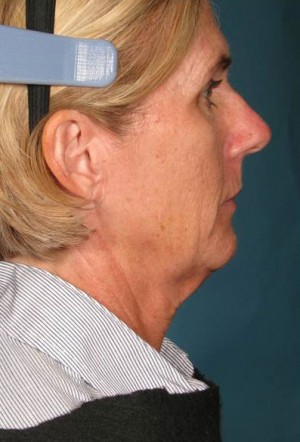 Ultherapy
