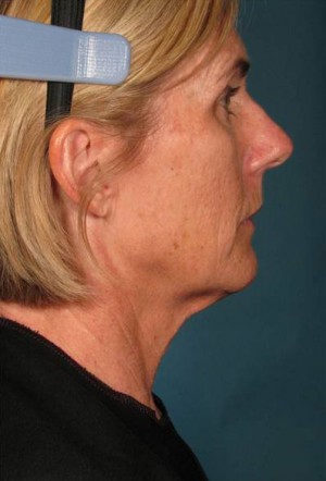 Ultherapy