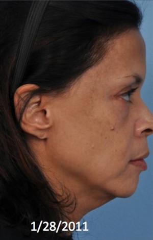 Ultherapy