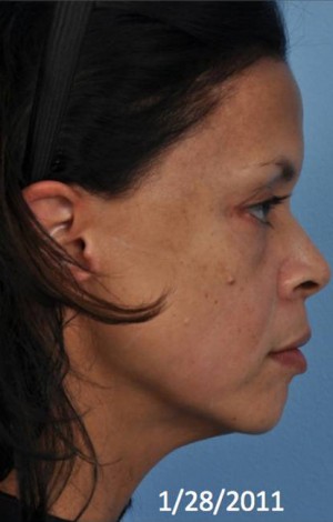 Ultherapy