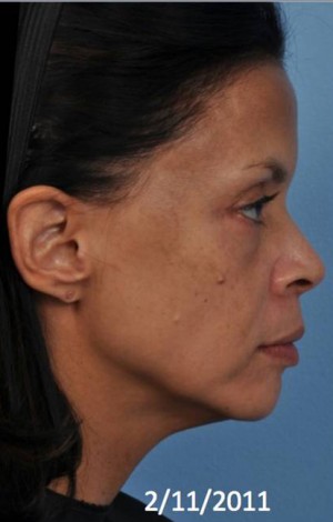 Ultherapy