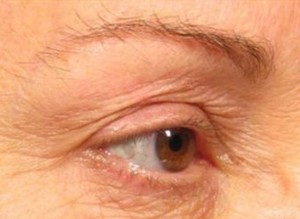 Ultherapy
