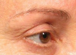 Ultherapy