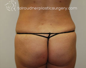 Liposuction