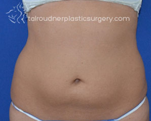 Liposuction