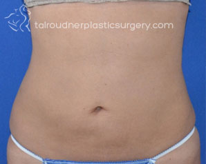 Liposuction