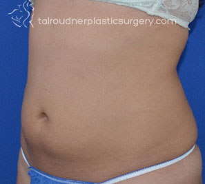 Liposuction