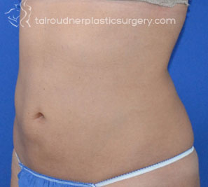 Liposuction