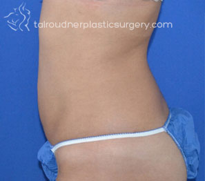 Liposuction