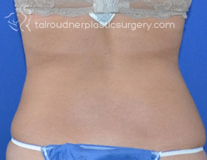 Liposuction