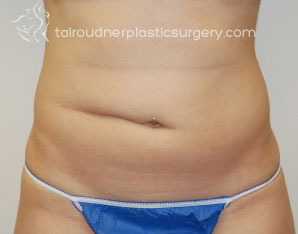 Liposuction