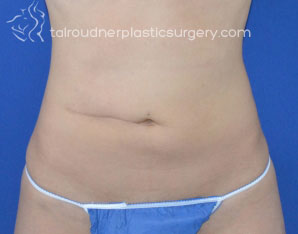 Liposuction