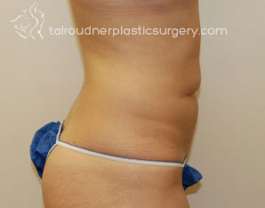 Liposuction