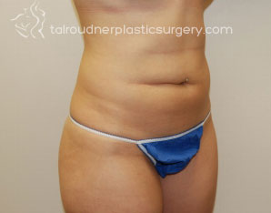 Liposuction
