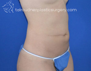 Liposuction