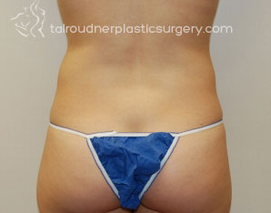 Liposuction