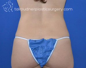 Liposuction