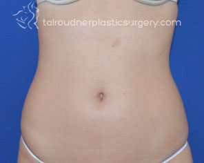 Liposuction
