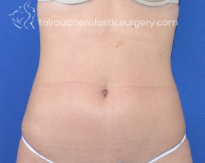 Liposuction