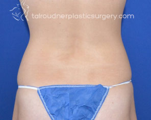 Liposuction