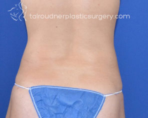 Liposuction