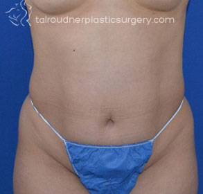 Liposuction