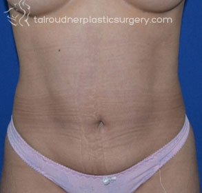 Liposuction