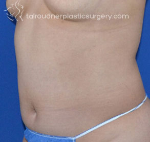 Liposuction