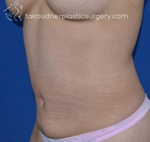 Liposuction