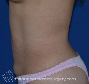 Liposuction