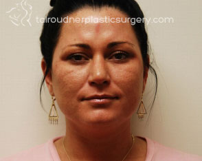 Liposuction