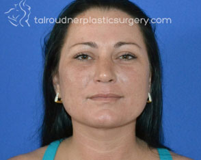 Liposuction