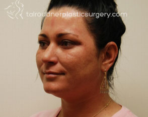 Liposuction