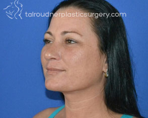Liposuction