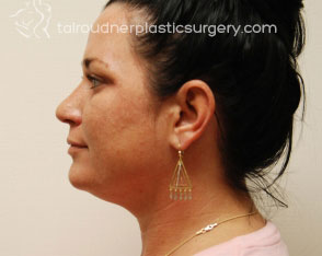 Liposuction