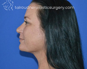 Liposuction