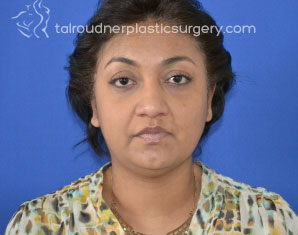 Liposuction