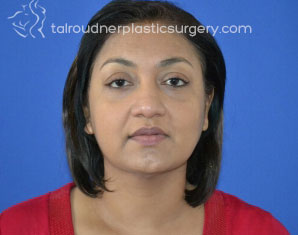 Liposuction