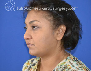 Liposuction