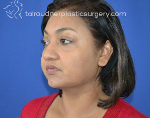 Liposuction