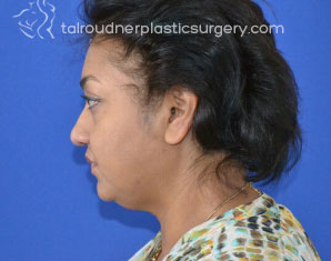 Liposuction