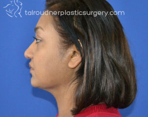 Liposuction