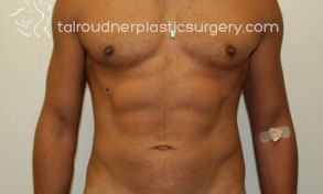 Liposuction