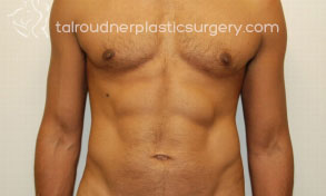 Liposuction