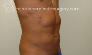 Liposuction